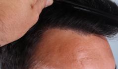Before Hair Transplant&nbsp;Front
